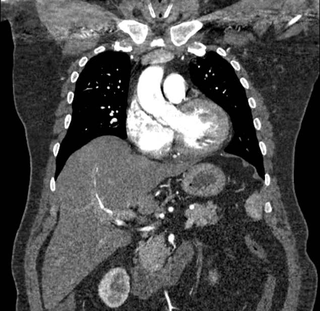 Acute pulmonary embolism with pulmonary infarcts (Radiopaedia 77688-89908 Coronal C+ CTPA 29).jpg