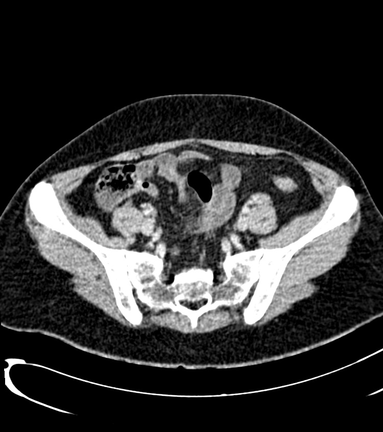 Acute pyelonephritis (Radiopaedia 40264-42816 Axial C+ portal venous phase 52).jpg
