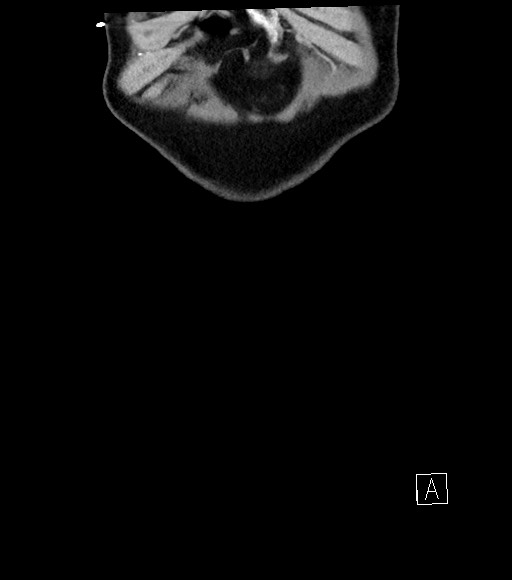 Acute renal infarction (Radiopaedia 59375-66736 Coronal C+ portal venous phase 4).jpg