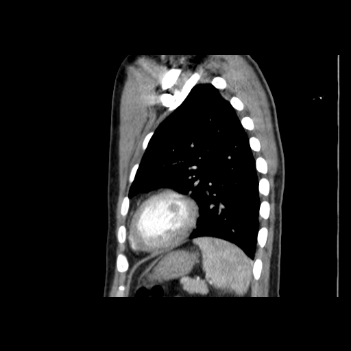 File:Acute segmental pulmonary emboli and pulmonary infarction (Radiopaedia 62264-70444 Sagittal C+ CTPA 50).jpg