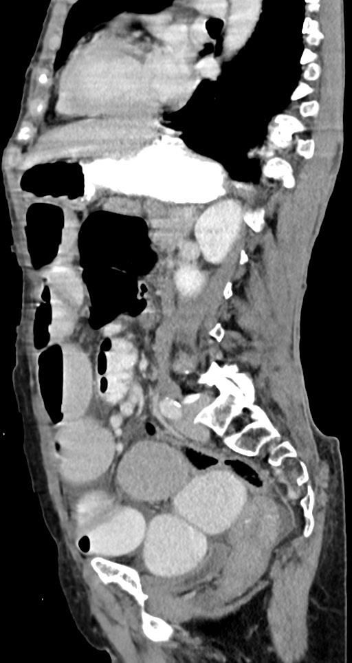 Acute small bowel (ileal) volvulus (Radiopaedia 71740-82139 Sagittal C+ portal venous phase 73).jpg
