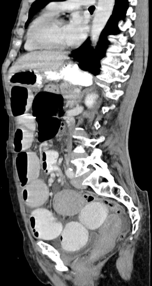 Acute small bowel (ileal) volvulus (Radiopaedia 71740-82139 Sagittal C+ portal venous phase 76).jpg