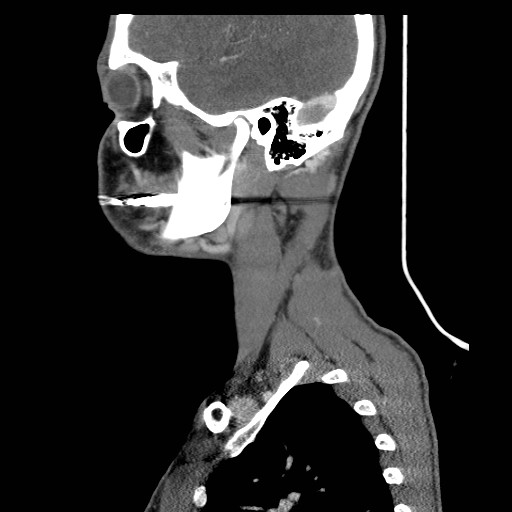 File:Acute submandibular sialadenitis secondary to ductal stone (Radiopaedia 27999-28267 Sagittal C+ delayed 37).jpg