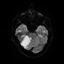 Acute superior cerebellar artery territory infarct (Radiopaedia 84104-99358 Axial DWI 23).jpg