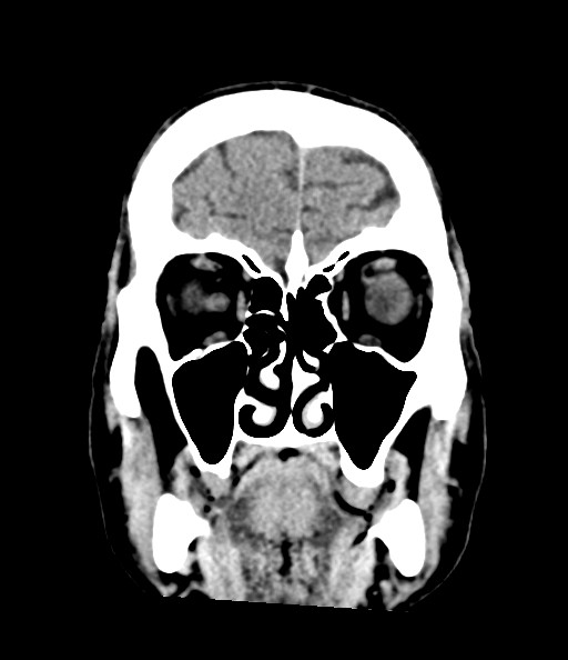 File:Acute superior cerebellar artery territory infarct (Radiopaedia 84104-99359 Coronal non-contrast 28).jpg