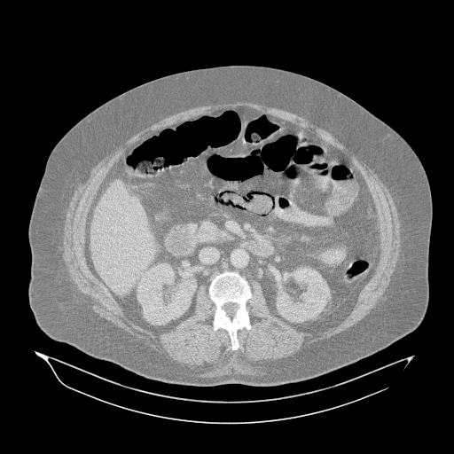 File:Acute superior mesenteric artery occlusion (Radiopaedia 51288-56960 Axial lung window 22).jpg