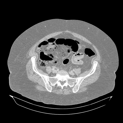 Acute superior mesenteric artery occlusion (Radiopaedia 51288-56960 Axial lung window 54).jpg