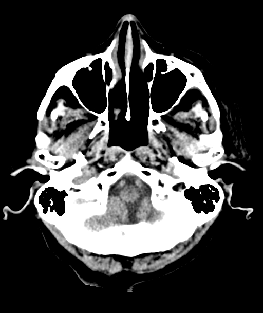 Acute traumatic subdural hematoma (Radiopaedia 82921-97257 Axial non-contrast 56).jpg