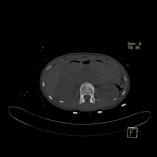 File:Acute vertebral compression fracture (Radiopaedia 63832-72559 Axial bone window 11).jpg