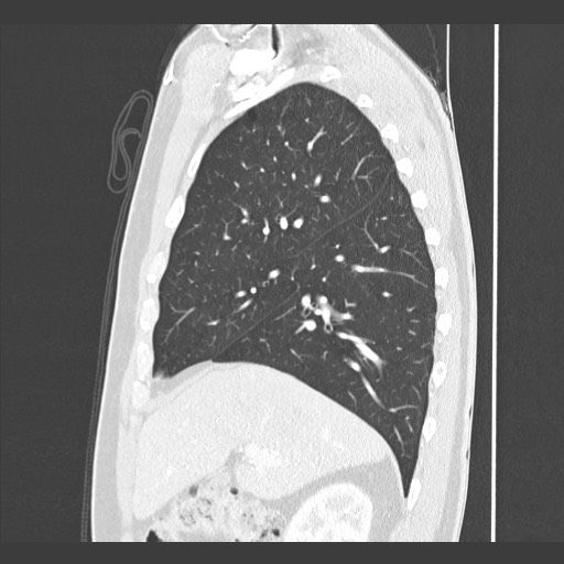 Adenocarcinoma of the lung (Radiopaedia 59871-67325 Sagittal lung window 29).jpg