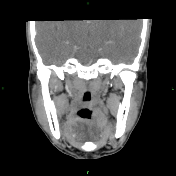 File:Adenoid cystic carcinoma of hard palate (Radiopaedia 26137-26273 Coronal liver window 20).jpg