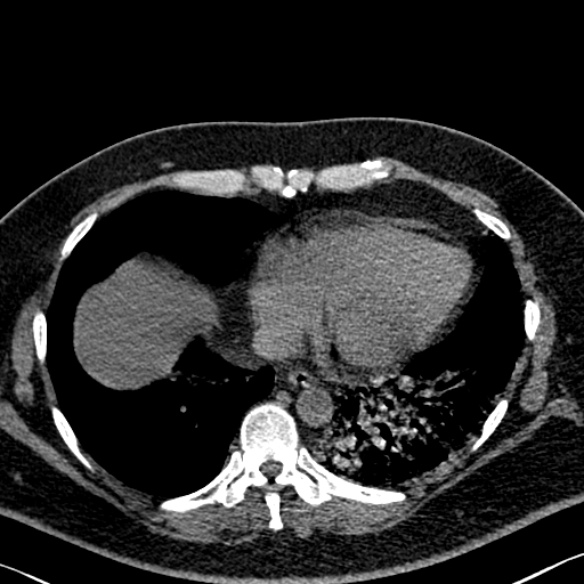 Adenoid cystic carcinoma of the trachea (Radiopaedia 49042-54137 Axial non-contrast 252).jpg
