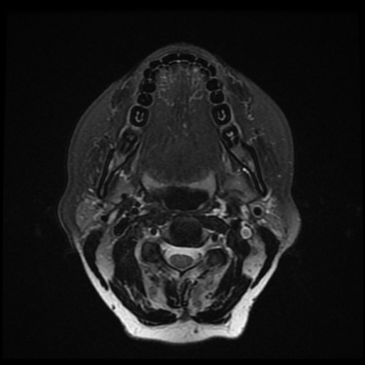 File:Adenoid cystic tumor of palate (Radiopaedia 46980-51519 Axial T2 fat sat 16).png