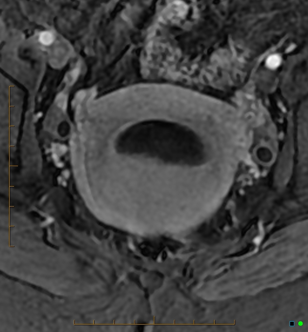 Adenomyosis uterus with hematometra (Radiopaedia 45779-50011 Axial T1 C+ fat sat 35).jpg