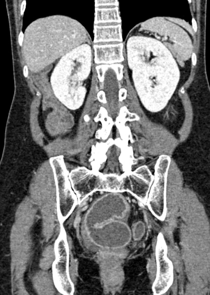 Adhesional small bowel obstruction (Radiopaedia 48397-53305 Coronal C+ portal venous phase 251).jpg