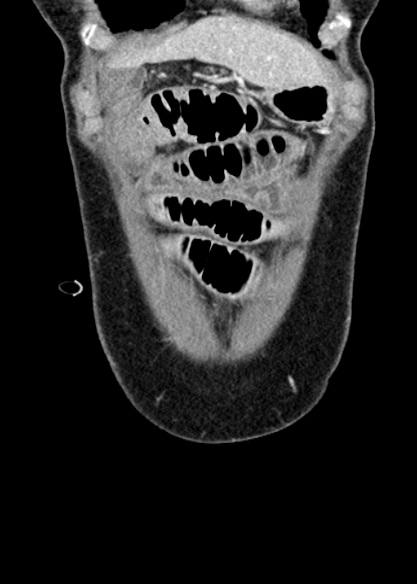 Adhesional small bowel obstruction (Radiopaedia 48397-53305 Coronal C+ portal venous phase 50).jpg