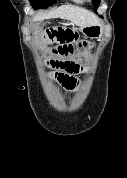 Adhesional small bowel obstruction (Radiopaedia 48397-53305 Coronal C+ portal venous phase 51).jpg