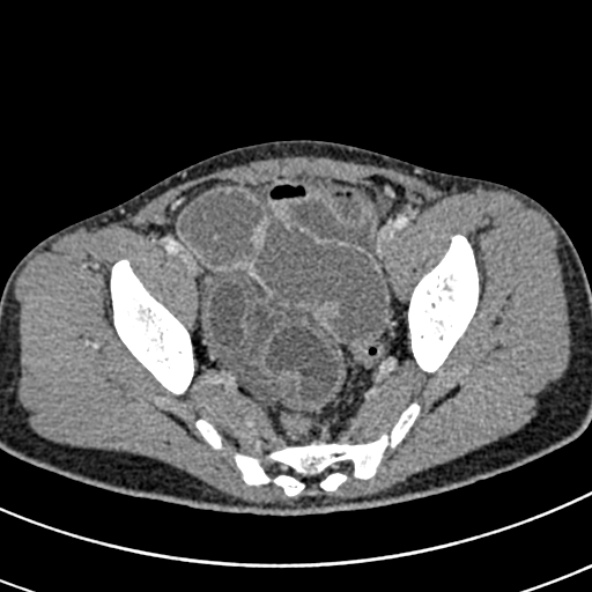 Adhesional small bowel obstruction (Radiopaedia 52107-57980 Axial C+ portal venous phase 110).jpg