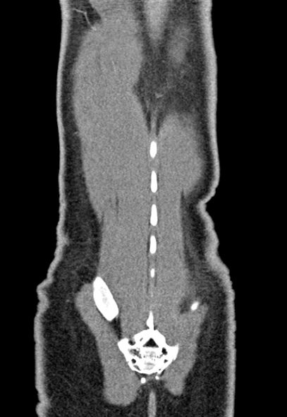 Adhesional small bowel obstruction (Radiopaedia 52107-57980 Coronal C+ portal venous phase 77).jpg