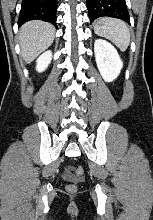Adhesional small bowel obstruction (Radiopaedia 58900-66131 Coronal C+ portal venous phase 195).jpg