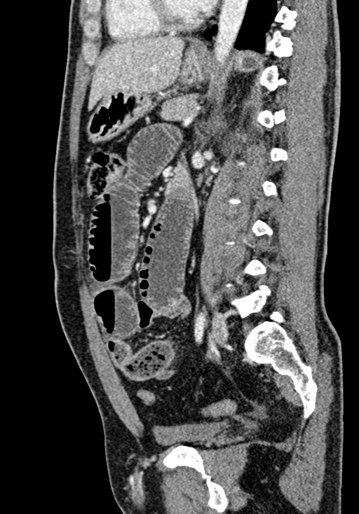 Adhesional small bowel obstruction (Radiopaedia 58900-66131 Sagittal C+ portal venous phase 147).jpg