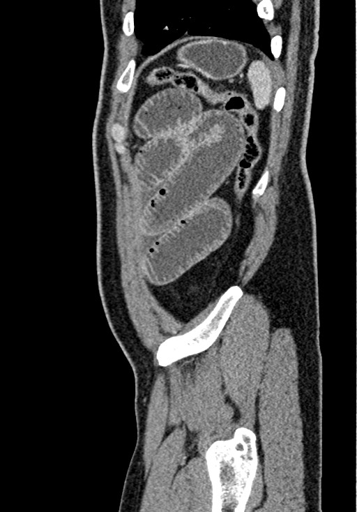 Adhesional small bowel obstruction (Radiopaedia 58900-66131 Sagittal C+ portal venous phase 218).jpg