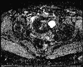 File:Adnexal multilocular cyst (O-RADS US 3. O-RADS MRI 3) (Radiopaedia 87426-103754 Axial 152).jpeg