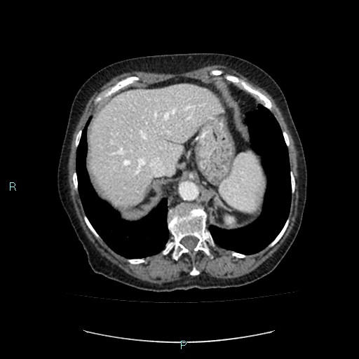 File:Adrenal collision tumor (ACT) (Radiopaedia 48462-53379 Axial C+ portal venous phase 9).jpg