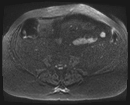 Adrenal cortical carcinoma (Radiopaedia 64017-72770 Axial DWI 126).jpg