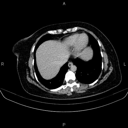 Adrenal cortical carcinoma (Radiopaedia 84882-100379 Axial C+ delayed 6).jpg