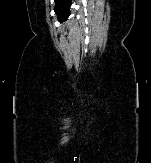 Adrenal cortical carcinoma (Radiopaedia 84882-100379 Coronal C+ portal venous phase 63).jpg