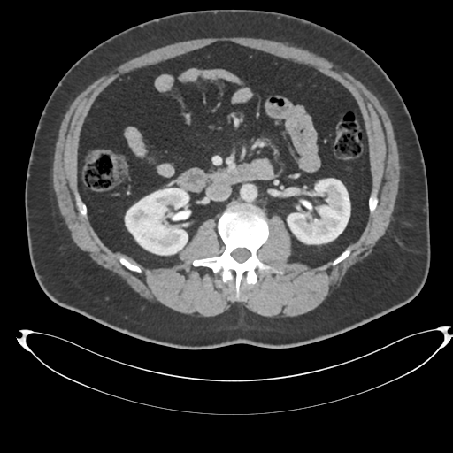 Adrenal cyst (Radiopaedia 45625-49778 AXIAL THICK 60 sec 40).png