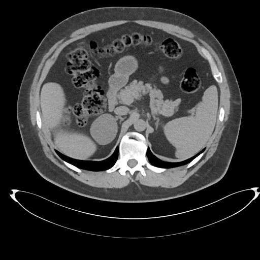 File:Adrenal cyst (Radiopaedia 45625-49778 Axial non-contrast 31).png