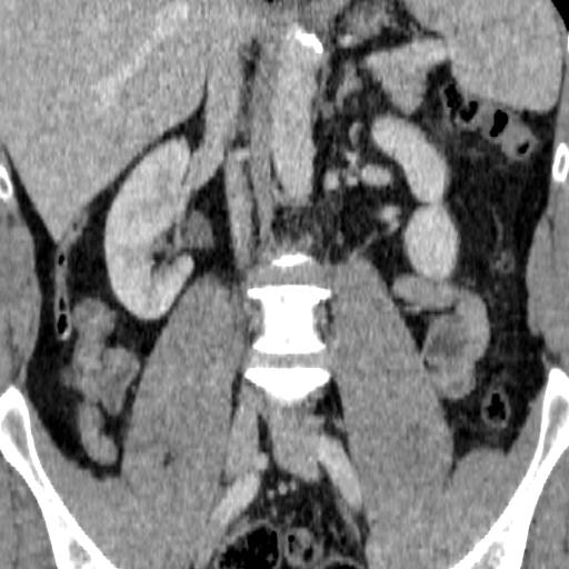 File:Adrenal glands (normal CT anatomy) (Radiopaedia 16570-105725 Coronal 3).jpg