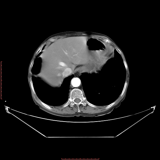 Adrenal hemangioma (Radiopaedia 68923-78668 Axial C+ arterial phase 19).jpg