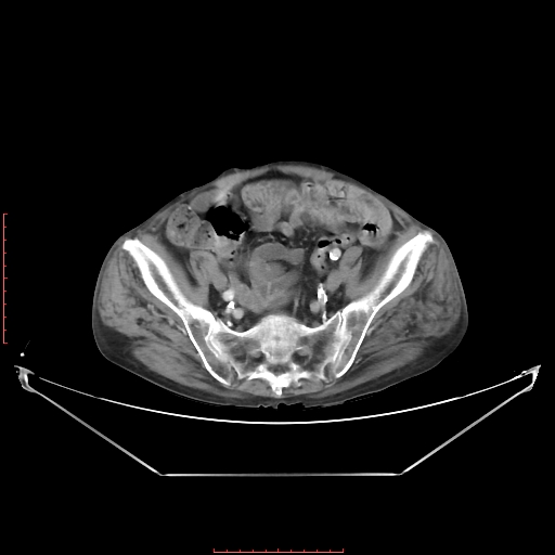 Adrenal hemangioma (Radiopaedia 68923-78668 Axial C+ portal venous phase 56).jpg