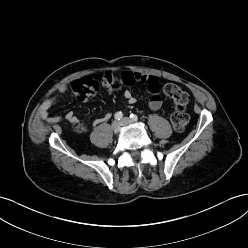 File:Adrenal lymphoma (Radiopaedia 73730-84529 Axial C+ portal venous phase 83).jpg