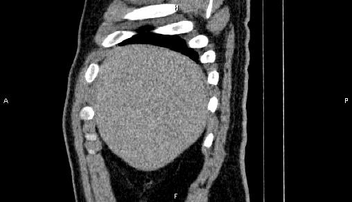 Adrenal myelolipoma (Radiopaedia 84321-99619 Sagittal non-contrast 13).jpg