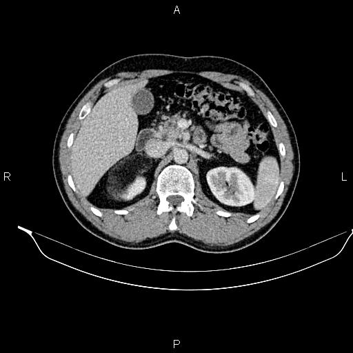Adrenal myelolipoma (Radiopaedia 87794-104246 Axial renal cortical phase 37).jpg