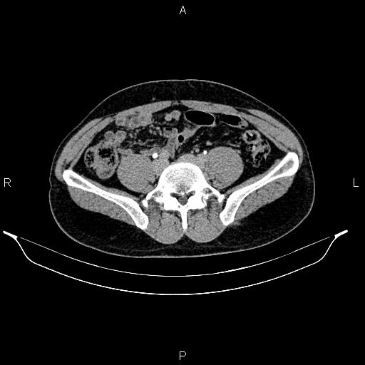 Adrenal myelolipoma (Radiopaedia 87794-104246 Axial renal excretory phase 70).jpg
