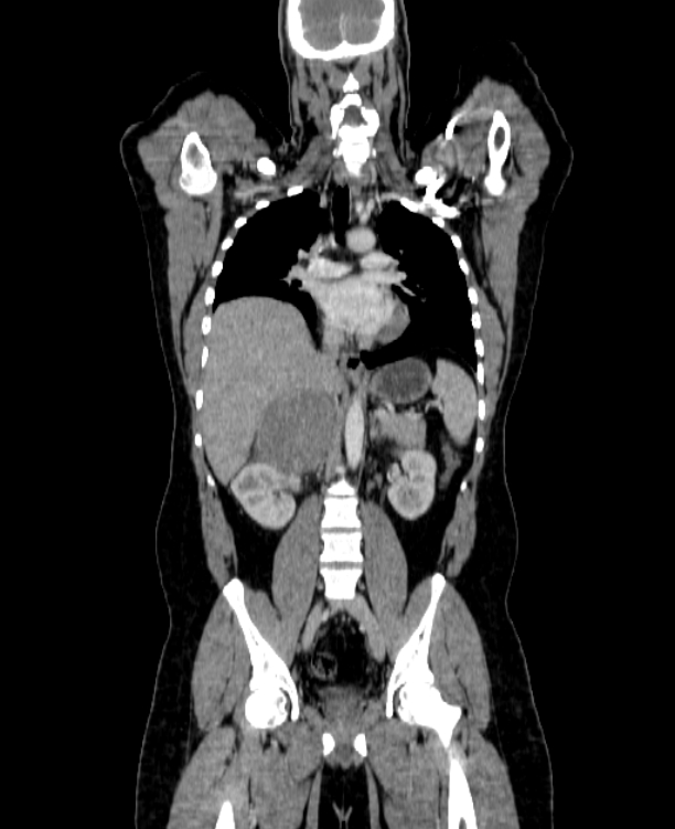 Adrenocortical carcinoma (Radiopaedia 80134-93438 Coronal C+ portal venous phase 94).jpg