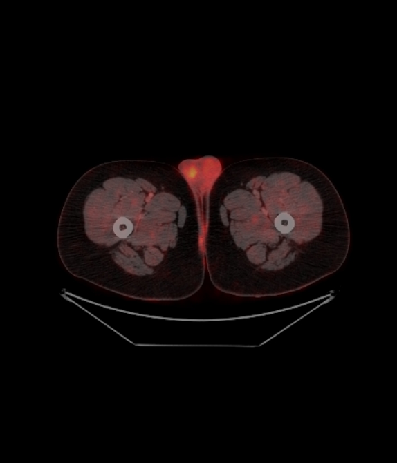 Adrenocortical carcinoma (Radiopaedia 80134-93440 ِAxial 284).jpg