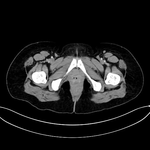 Adrenocortical carcinoma (Radiopaedia 87281-103569 Axial C+ portal venous phase 91).jpg