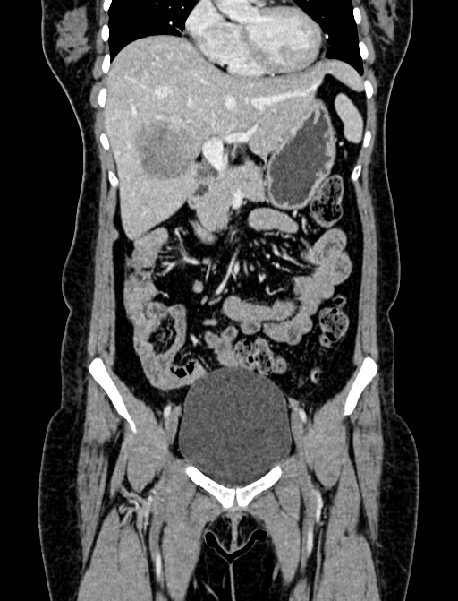 Adrenocortical carcinoma (Radiopaedia 87281-103569 Coronal C+ portal venous phase 10).jpg