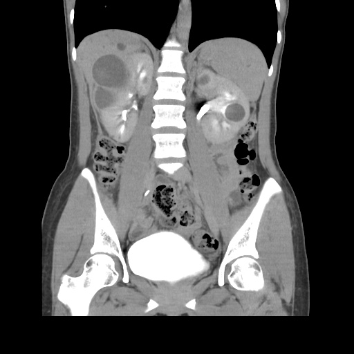 File:Adult polycystic kidney disease (Radiopaedia 48845-53876 Coronal renal excretory phase 24).jpg