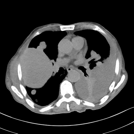 Advanced metastatic lung cancer (Radiopaedia 48910-53954 Axial non-contrast 34).png