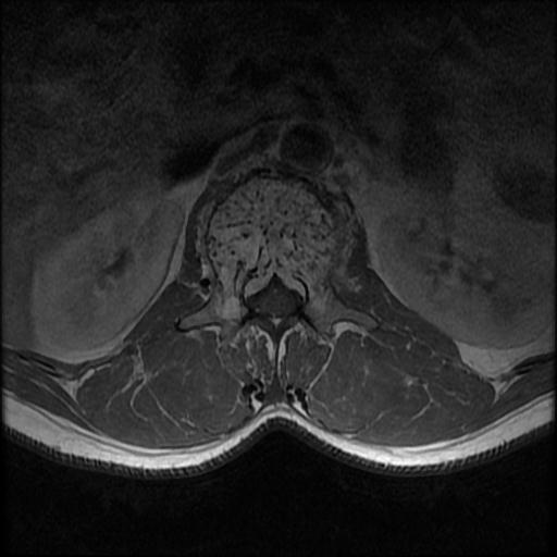 File:Aggressive vertebral hemangioma with pathological fracture (Radiopaedia 69528-79411 Axial T1 C+ 13).jpg