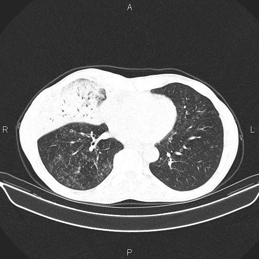 File:Air bronchogram in pneumonia (Radiopaedia 85719-101512 Axial lung window 44).jpg