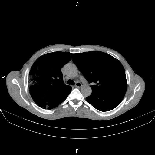 Air bronchogram in pneumonia (Radiopaedia 85719-101512 Axial non-contrast 25).jpg