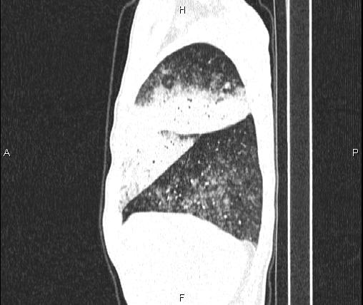 File:Air bronchogram in pneumonia (Radiopaedia 85719-101512 Sagittal lung window 18).jpg